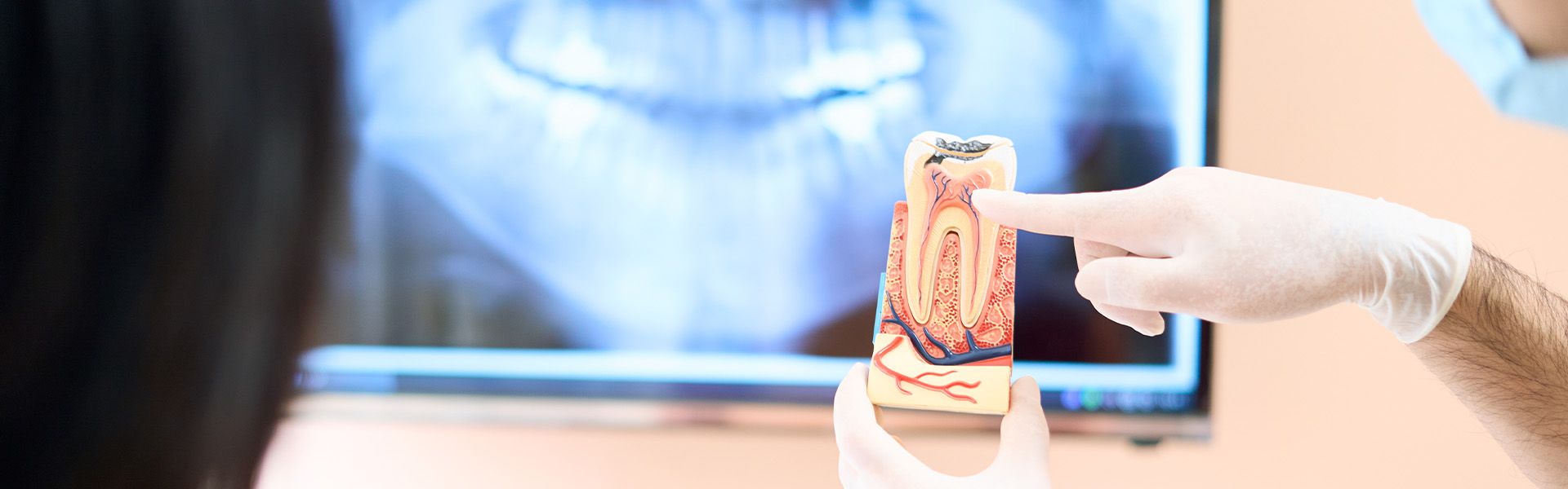 虫歯治療｜前橋市関根町の歯医者・歯科医院なら【リップル歯科・矯正歯科クリニック】