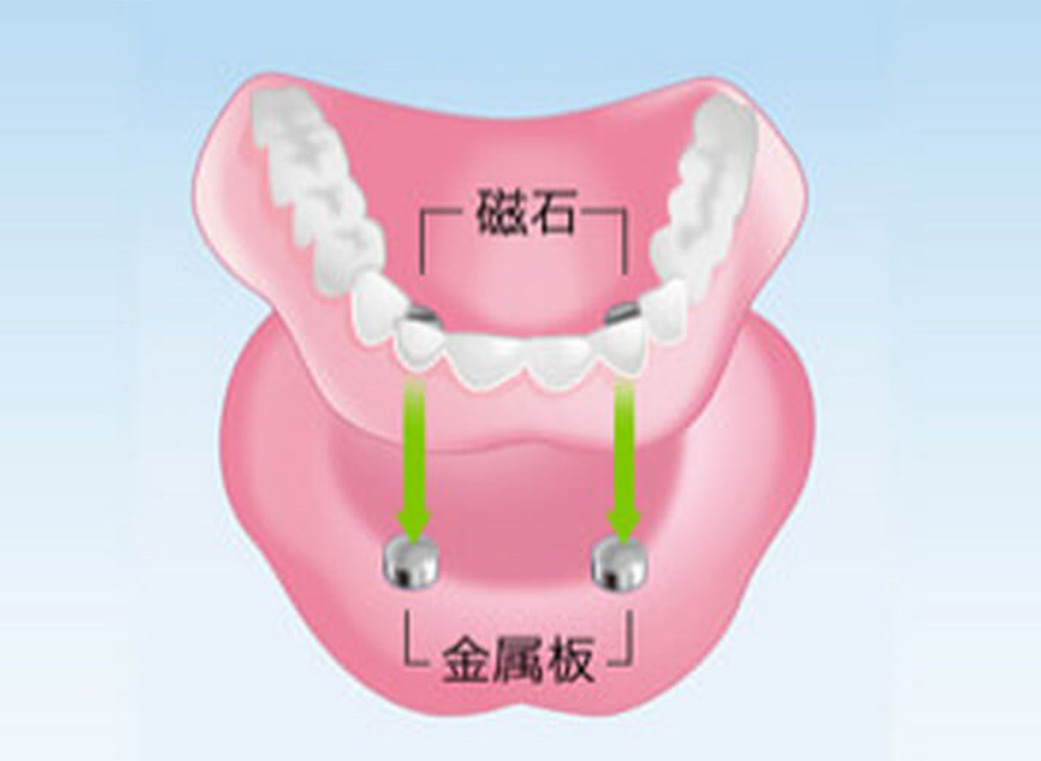入れ歯｜前橋市関根町の歯医者・歯科医院なら【リップル歯科・矯正歯科クリニック】