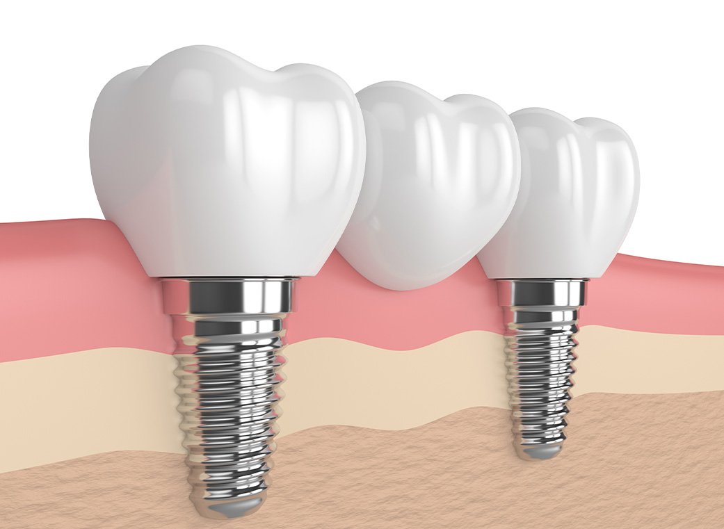 インプラント｜前橋市関根町の歯医者・歯科医院なら【リップル歯科・矯正歯科クリニック】