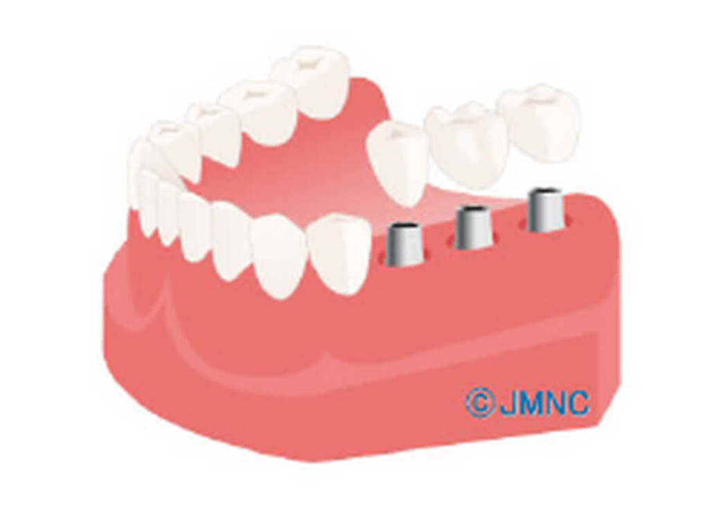 人工歯の成形・装着