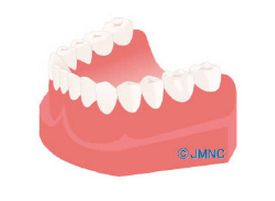 インプラント治療後のメンテナンス