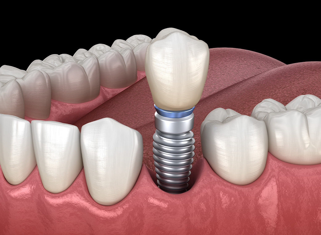 インプラント｜前橋市関根町の歯医者・歯科医院なら【リップル歯科・矯正歯科クリニック】