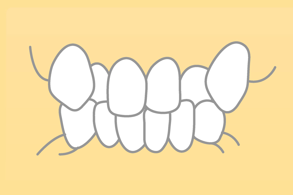 小児の乱ぐい歯・叢生（そうせい）