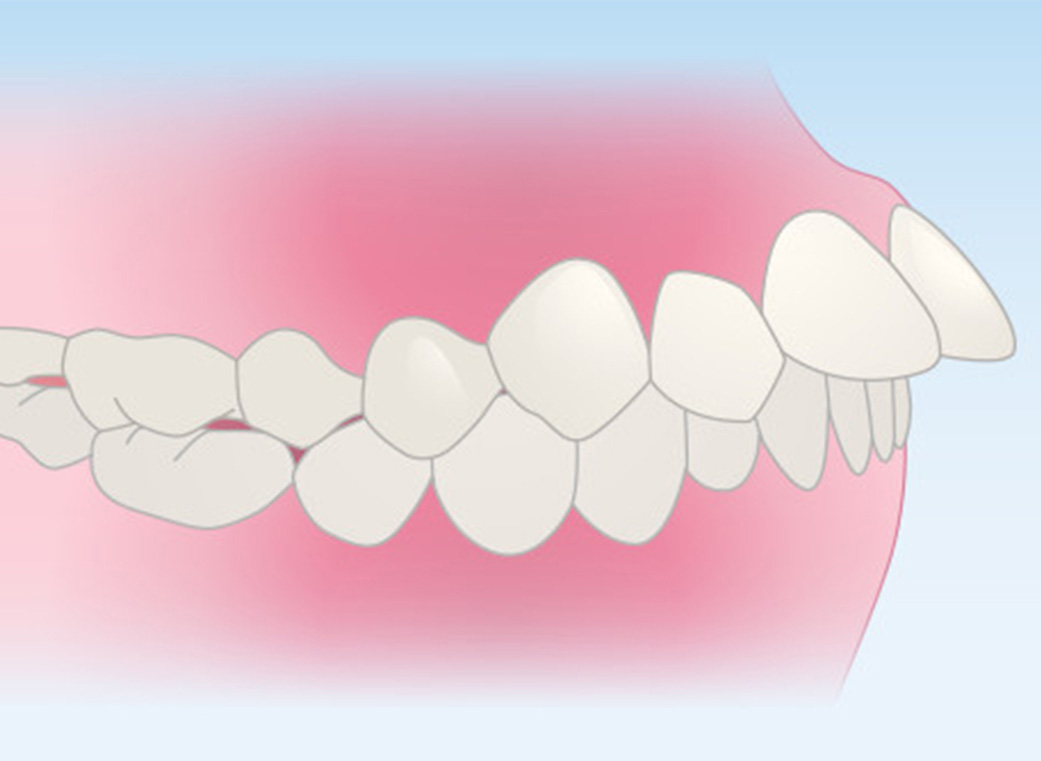出っ歯（上顎前突＜じょうがくぜんとつ＞）