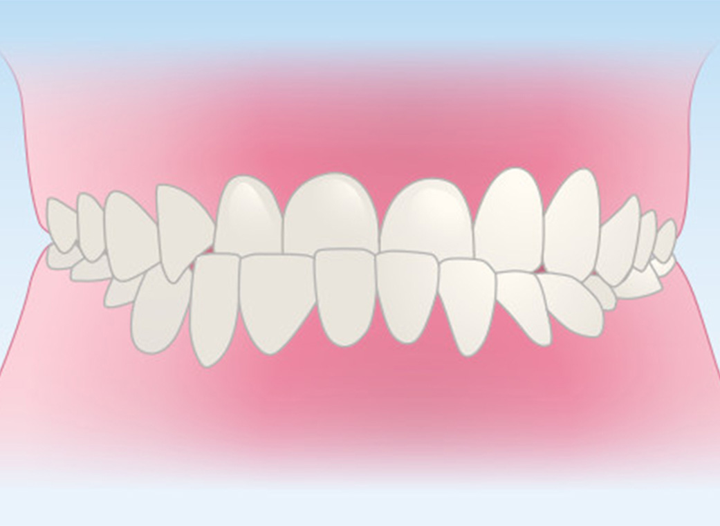 受け口、反対咬合（下顎前突＜かがくぜんとつ＞）