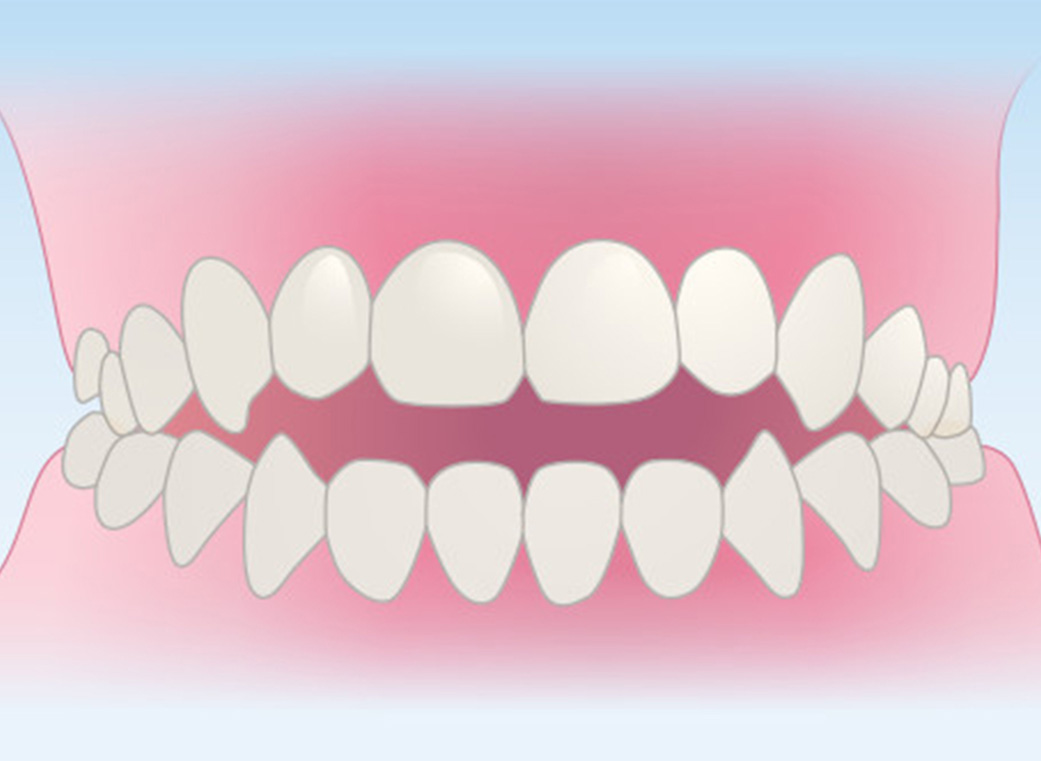 口が開いた状態（開咬＜かいこう＞）