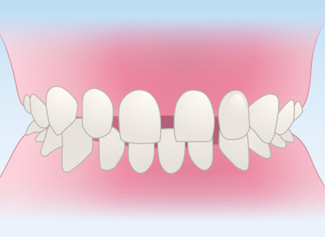 すきっ歯（空隙歯列＜くうげきしれつ＞）