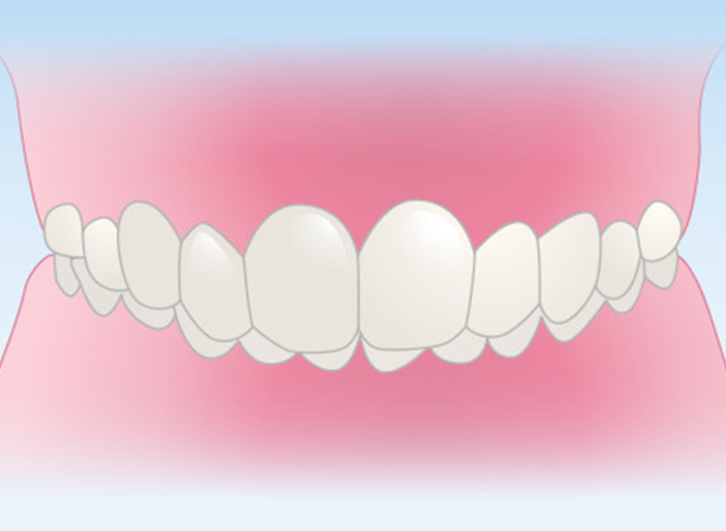 深いかみ合わせ（過蓋咬合＜かがいこうごう＞）