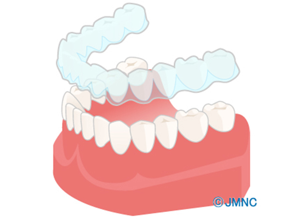 インビザライン