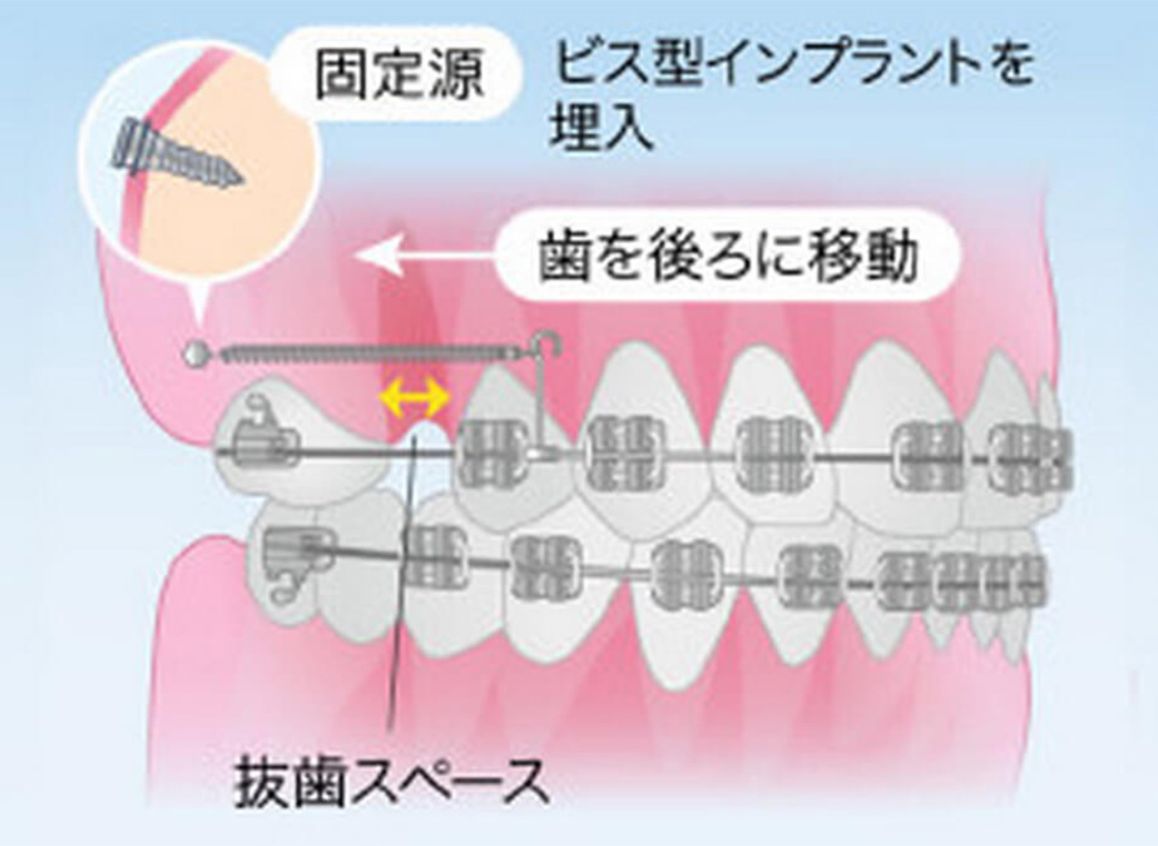 アンカースクリュー