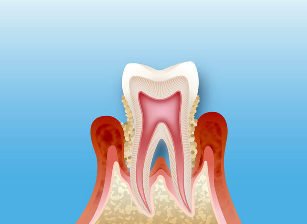 歯周病治療｜前橋市関根町の歯医者・歯科医院なら【リップル歯科・矯正歯科クリニック】