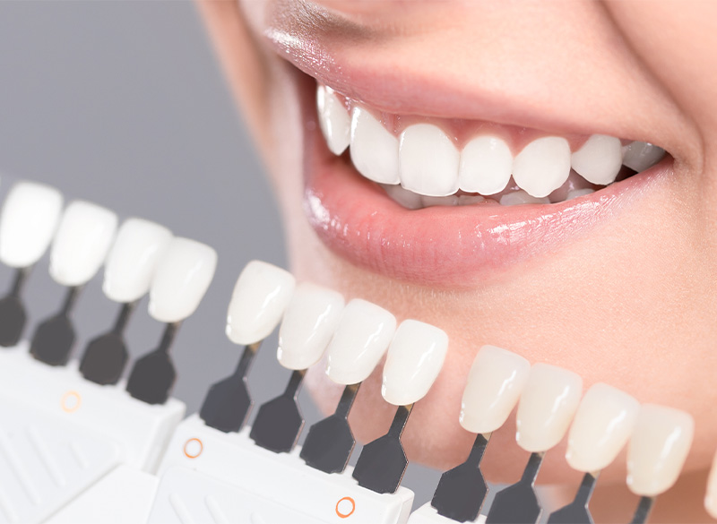 ホワイトニング