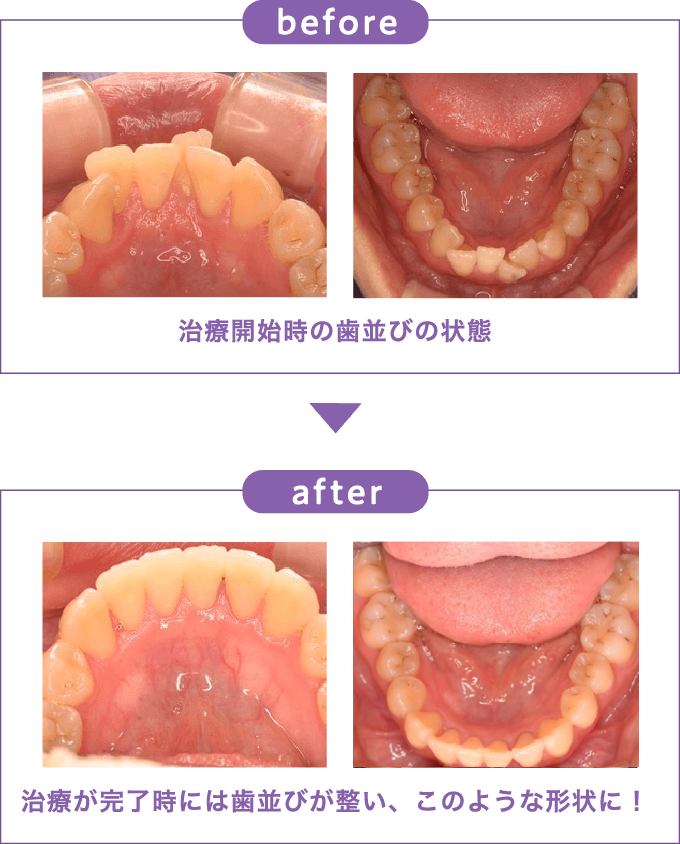 before:治療開始時の歯並びの状態 after:治療が完了時には歯並びが整い、このような形状に！