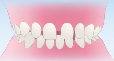 06空隙歯列 歯と歯の間に隙間がある“すきっ歯”